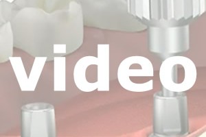dental implants video