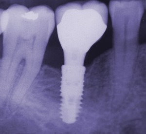 a dental implant 