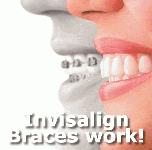 philadelphia preferred provider of Invisalign Clear Braces