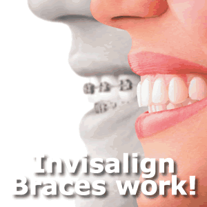 philadelphia preferred provider of Invisalign Clear Braces